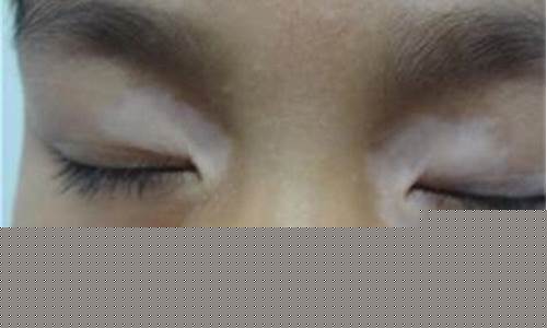 眼角白膜堆积图片(感觉眼角有一层膜堆积图片)_https://www.shscx.com_玉米_第1张